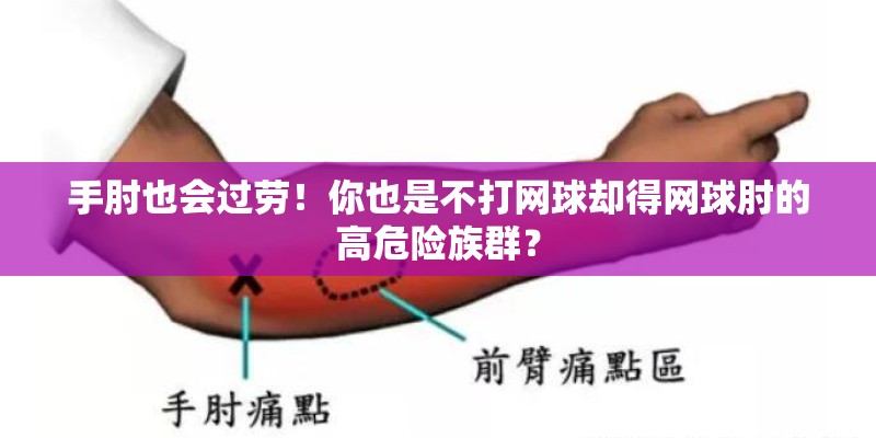 手肘也会过劳！你也是不打网球却得网球肘的高危险族群？